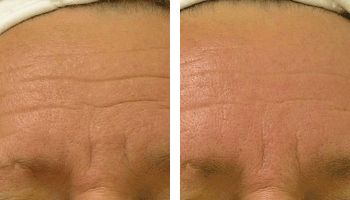 Hydafacial wrinkles reduction